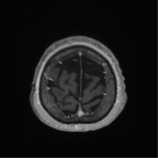 Anaplastic astrocytoma IDH wild-type (pseudoprogression) (Radiopaedia 42209-45278 Axial T1 C+ 135).png