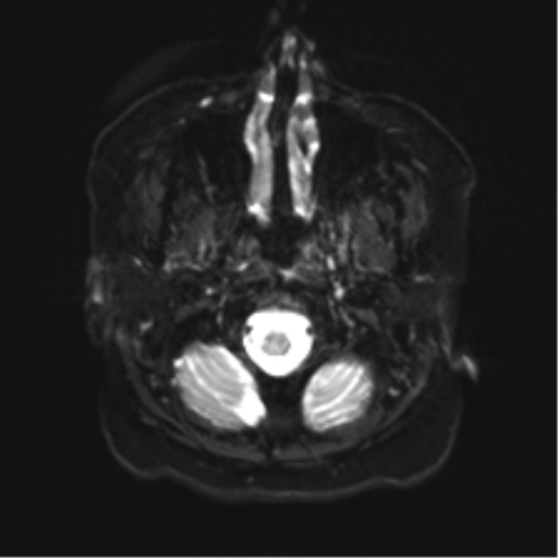 File:Anaplastic astrocytoma IDH wild-type (pseudoprogression) (Radiopaedia 42209-45279 Axial DWI 2).png