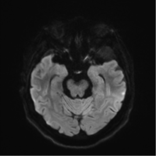 Anaplastic astrocytoma IDH wild-type (pseudoprogression) (Radiopaedia 42209-45279 Axial DWI 37).png