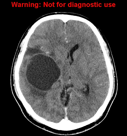 File:Anaplastic ganglioglioma (Radiopaedia 44921-48815 B 14).jpg
