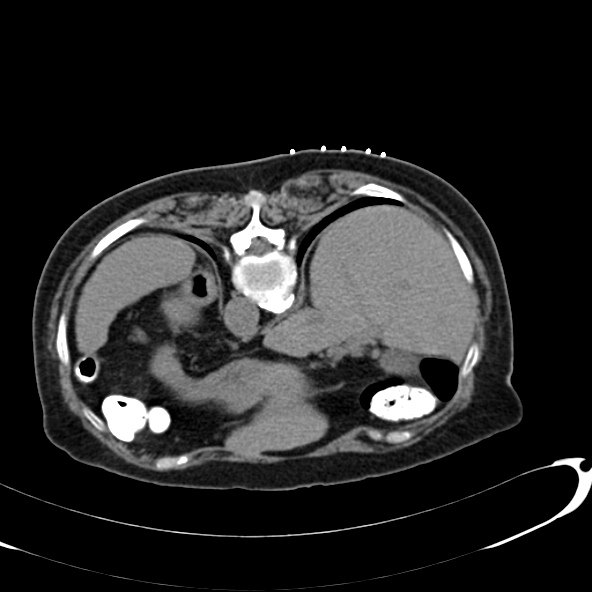 Anaplastic lymphoma - with CT biopsy (Radiopaedia 21643-21602 Axial non-contrast 2).jpg