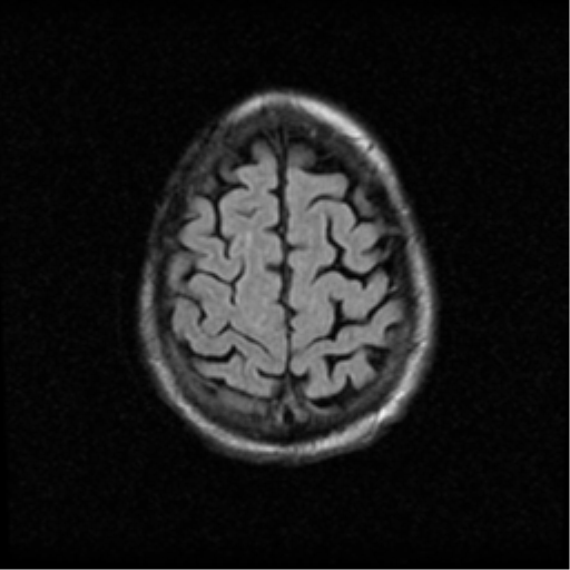 File:Anaplastic meningioma with recurrence (Radiopaedia 34452-35789 Axial FLAIR 20).png