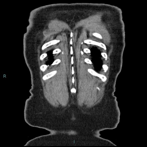Aneurysm of the inferior vena cava (Radiopaedia 65330-74361 C 95).jpg