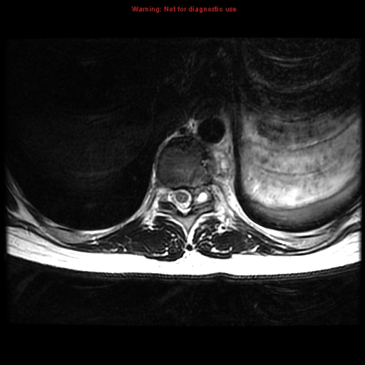 File:Aneurysmal bone cyst (Radiopaedia 9419-10103 Axial T2 9).jpg