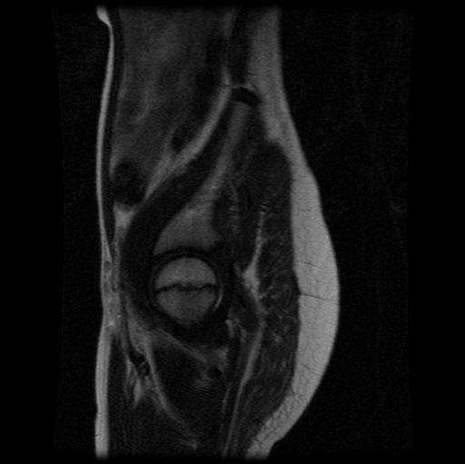File:Aneurysmal bone cyst - sacrum (Radiopaedia 65190-74196 Sagittal T2 28).jpg