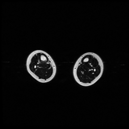 File:Aneurysmal bone cyst - tibia (Radiopaedia 22343-22367 Axial T2 6).jpg