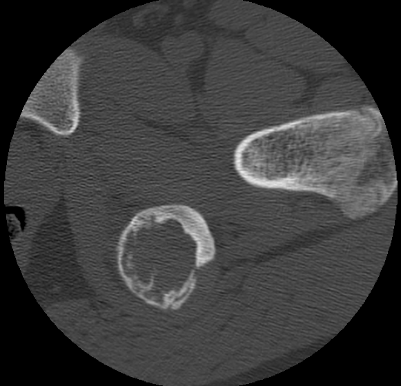 Aneurysmal bone cyst of ischium (Radiopaedia 25957-26094 B 29).png