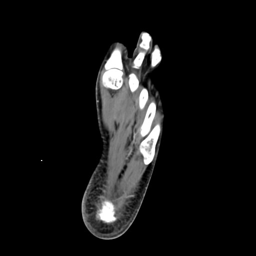 File:Aneurysmal bone cyst of the calcaneus (Radiopaedia 60669-68421 A 39).jpg