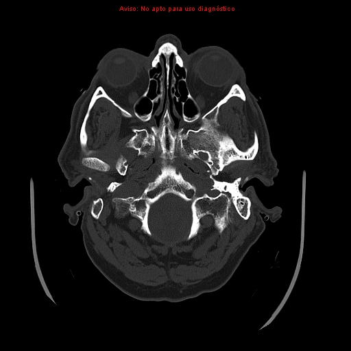 File:Aneurysmal subarachnoid hemorrhage (Radiopaedia 24740-24997 bone window 4).jpg