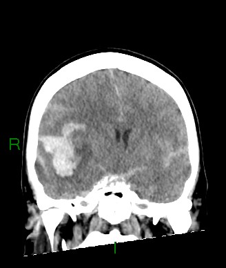 Aneurysmal subarachnoid hemorrhage with intra-axial extension (Radiopaedia 84371-99699 Coronal non-contrast 39).jpg