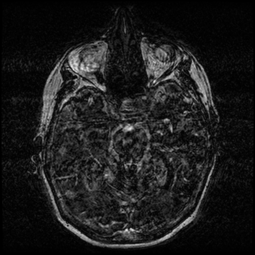 Angioinvasive aspergillosis in the pituitary fossa (Radiopaedia 39676-42010 Ax 3D FIESTA VOLUME 51).png