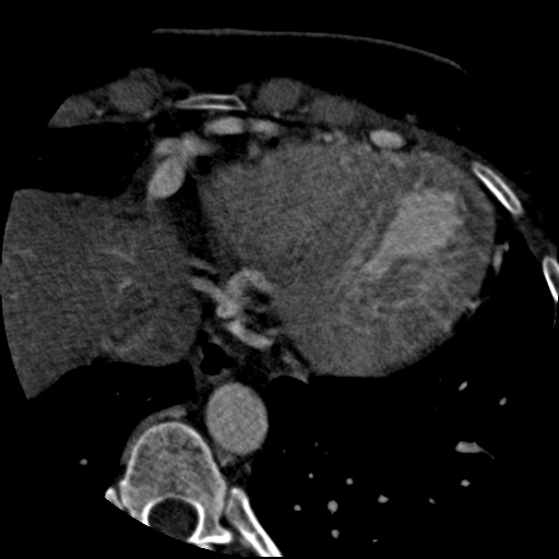 File:Anomalous left coronary artery from the pulmonary artery (ALCAPA) (Radiopaedia 40884-43586 A 72).jpg