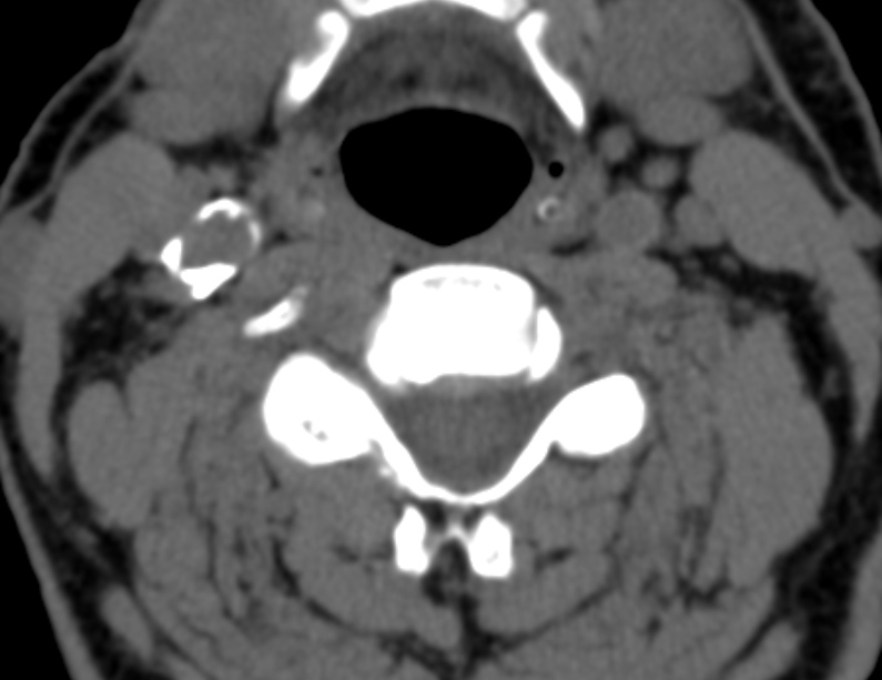 Anterior cervical postdiscectomy arthrodesis (Radiopaedia 32678-33646 Axial non-contrast 39).jpg