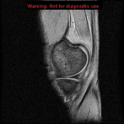 File:Anterior cruciate ligament injury - partial thickness tear (Radiopaedia 12176-12515 A 3).jpg