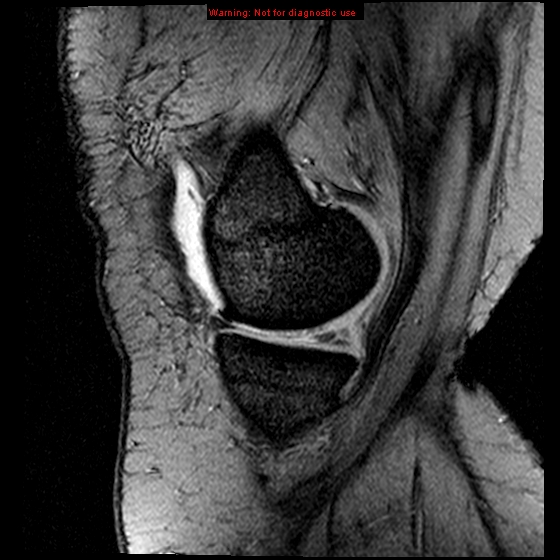 File:Anterior cruciate ligament tear (Radiopaedia 12329-12612 A 16).jpg