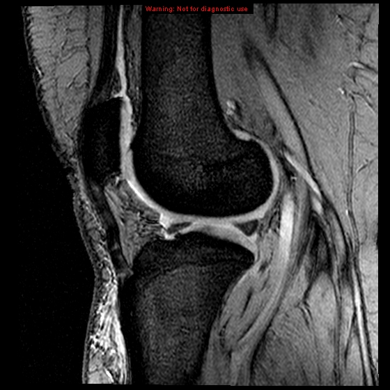 File:Anterior cruciate ligament tear (Radiopaedia 12329-12612 A 8).jpg