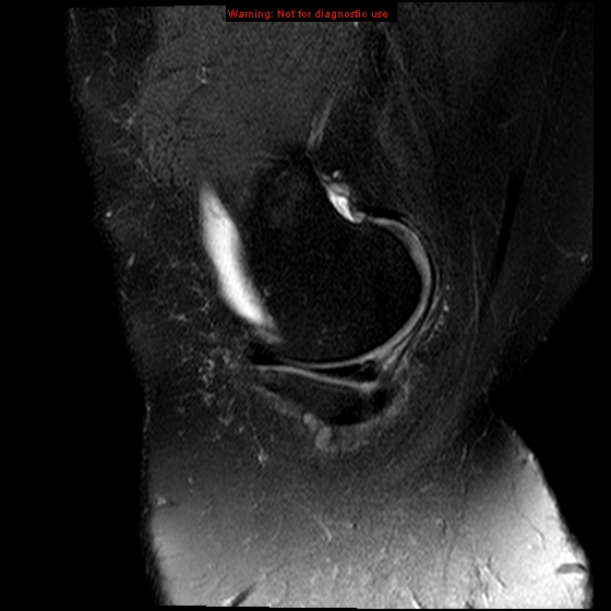 File:Anterior cruciate ligament tear (Radiopaedia 12329-12612 E 18).jpg