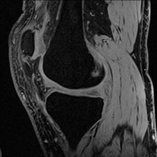Anterior cruciate ligament tear - ramp lesion (Radiopaedia 71883-82322 Sagittal T1 vibe 90).jpg