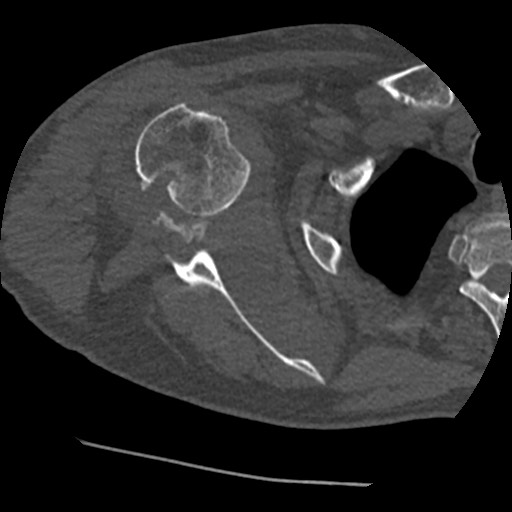 File:Anterior glenohumeral dislocation with Hill-Sachs lesion (Radiopaedia 62877-71249 Axial bone window 44).jpg