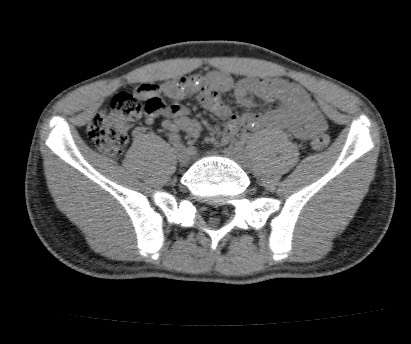 File:Anterior inferior iliac spine avulsion fracture (Radiopaedia 81312-94999 Axial non-contrast 23).jpg