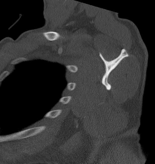 Anterior shoulder dislocation with Hill-Sachs and bony Bankart lesions (Radiopaedia 40424-42974 Sagittal bone window 34).png