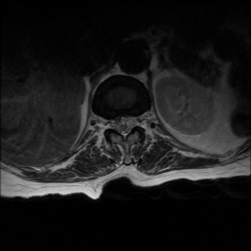 File:Anterior spinal artery syndrome (Radiopaedia 46335-50750 Axial T2 26).png