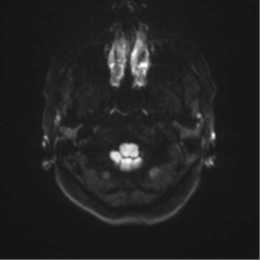 Anterior temporal lobe perivascular space (Radiopaedia 40946-43650 Axial DWI 28).png