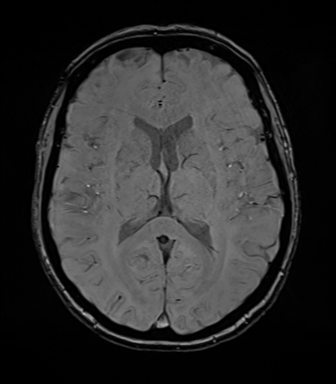 File:Anterior temporal lobe perivascular space (Radiopaedia 40946-43650 Axial SWI 47).png