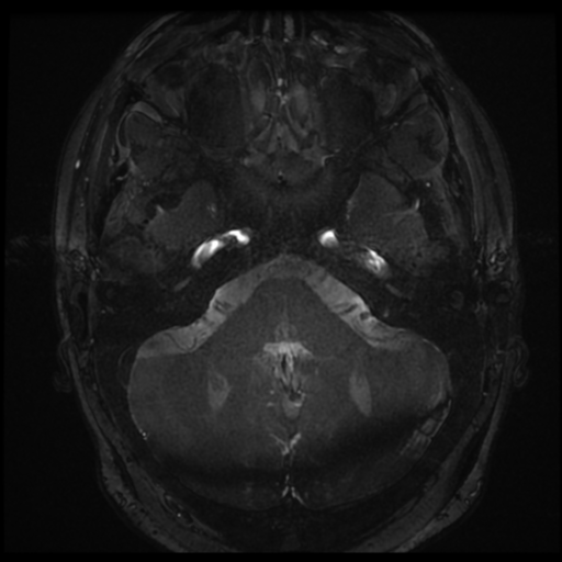 Anterior temporal lobe perivascular space (Radiopaedia 68481-78041 E 1).png
