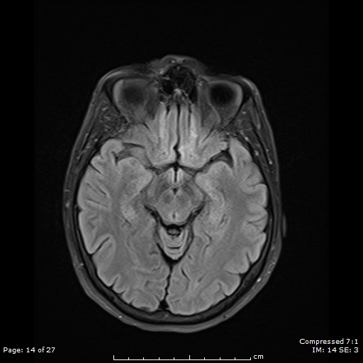 File:Anterior temporal lobe perivascular space (Radiopaedia 88283-104914 Axial FLAIR 14).jpg