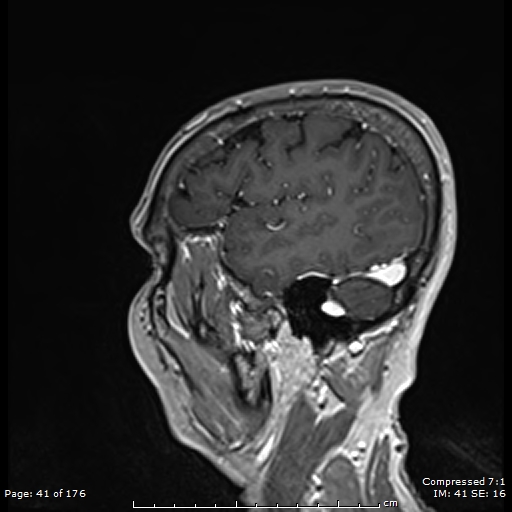 File:Anterior temporal lobe perivascular space (Radiopaedia 88283-104914 Sagittal T1 C+ 2).jpg
