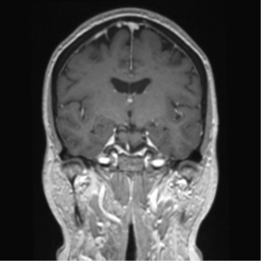 Anterior temporal pole cysts (Radiopaedia 46629-51102 Coronal T1 C+ 91).png