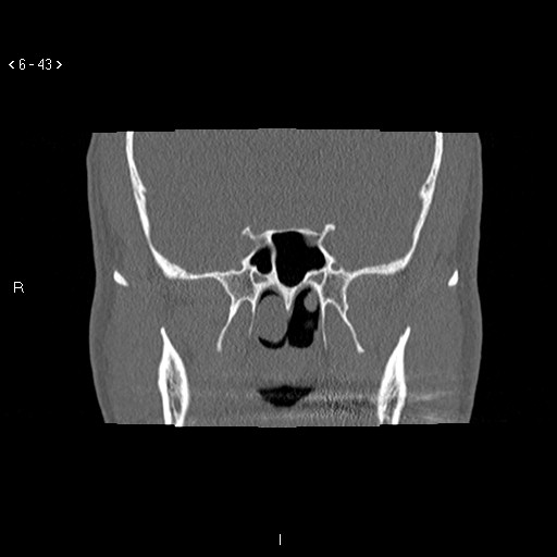 File:Antrochoanal Polyp (Radiopaedia 70510-80631 Coronal bone window 32).jpg