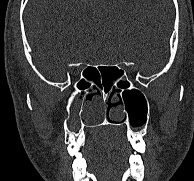File:Antrochoanal polyp (Radiopaedia 30002-30554 Coronal bone window 50).jpg