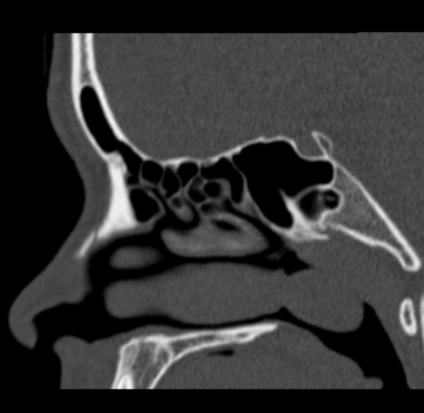 File:Antrochoanal polyp (Radiopaedia 33984-35202 Sagittal bone window 46).jpg