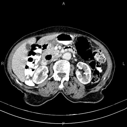 Aortic aneurysm and Lemmel syndrome (Radiopaedia 86499-102554 A 35).jpg