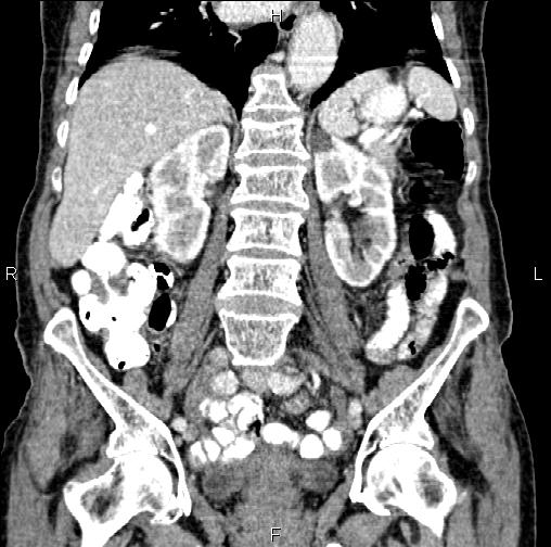 Aortic aneurysm and Lemmel syndrome (Radiopaedia 86499-102554 C 37).jpg