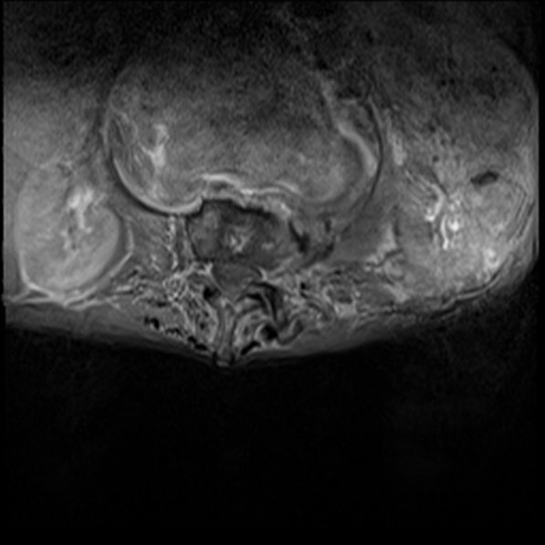 File:Aortic aneurysm with spinal destruction (Radiopaedia 42301-45409 Axial T1 fat sat 10).jpg