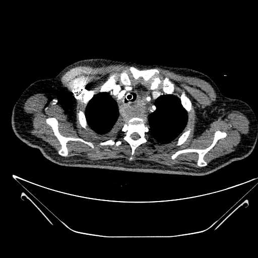 Aortic arch aneurysm (Radiopaedia 84109-99365 B 109).jpg