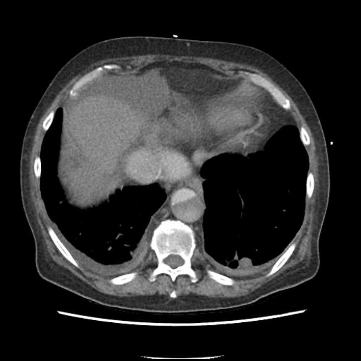 Aortic arch graft infection (FDG PET-CT) (Radiopaedia 71975-82437 A 51).jpg