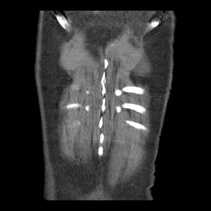 Aortic arch graft infection (FDG PET-CT) (Radiopaedia 71975-82437 Coronal 57).jpg