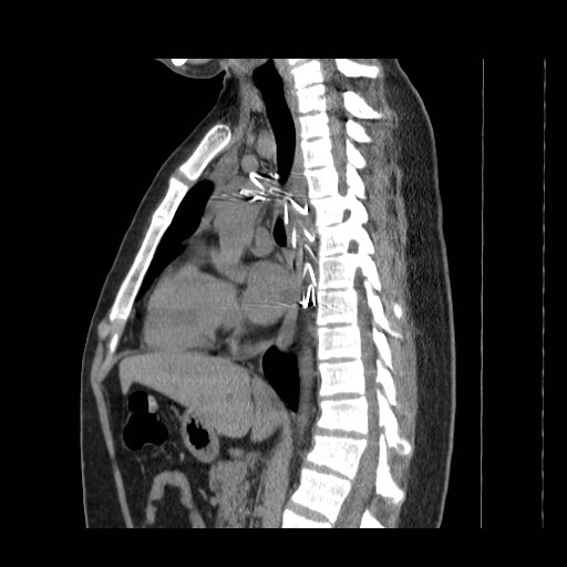 File:Aortic arch stent (Radiopaedia 30030-30595 B 9).jpg