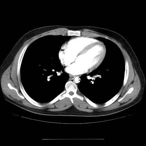 File:Aortic arch stent (Radiopaedia 30030-30595 D 24).jpg