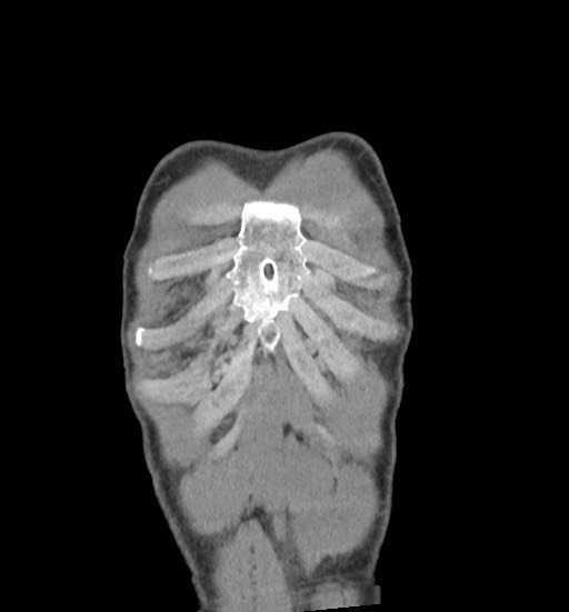 Aortic coarctation with aneurysm (Radiopaedia 74818-85828 C 10).jpg