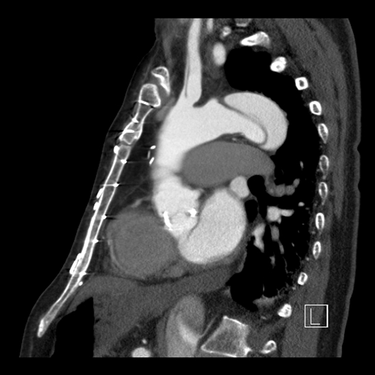File:Aortic dissection (CTPA) (Radiopaedia 75506-86750 C 63).jpg