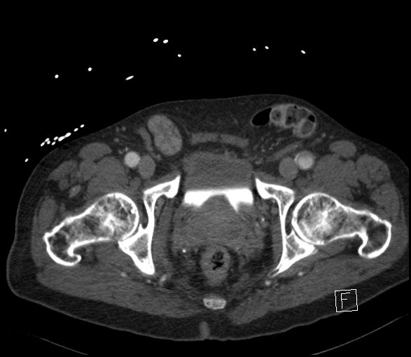 Aortic dissection (CTPA) (Radiopaedia 75506-86750 E 147).jpg