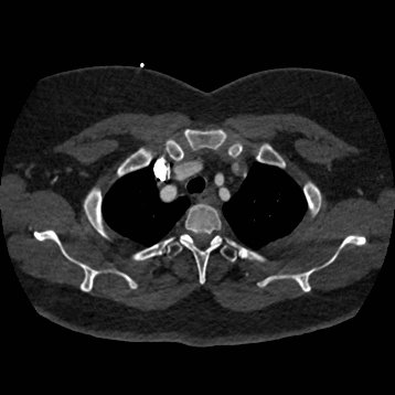 Aortic dissection (Radiopaedia 57969-64959 A 60).jpg