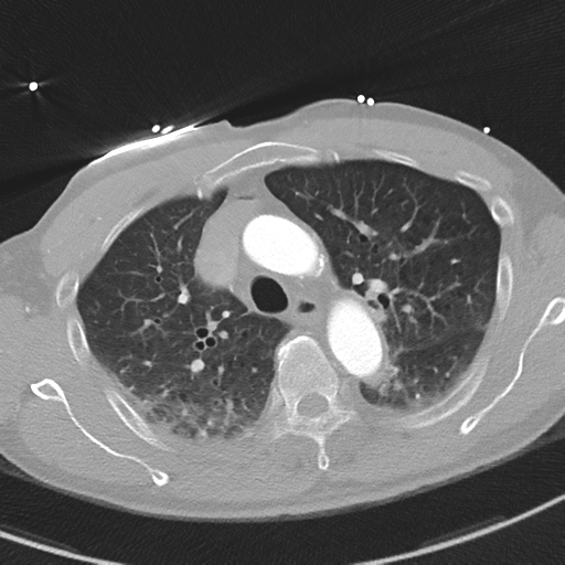 Aortic dissection - DeBakey type II (Radiopaedia 64302-73082 Axial lung window 19).png