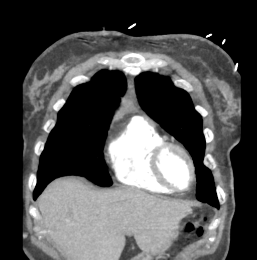 Aortic dissection - Stanford type B (Radiopaedia 50171-55512 B 19).png