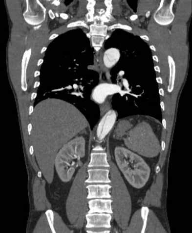 File:Aortic dissection - Stanford type B (Radiopaedia 73648-84437 B 76).jpg